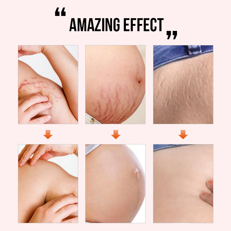 Scar Repair Cream Acne Scars Remove Pregnant Women Skin Care - 图2