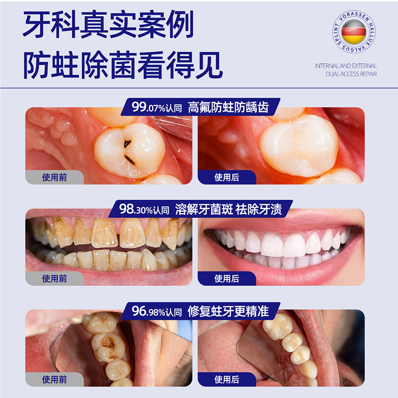 沃朗森牙膏防蛀抗敏含氟成人蛀牙龋齿修复专用医用美白去黄去口臭