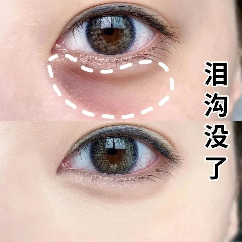 泪沟去除神器改善眼部凹陷填充修复跟泪沟说拜拜祛眼袋提拉遮瑕贴_虎窝淘