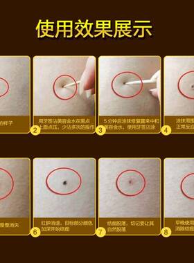 美容金水凸痣黑痣点斑水