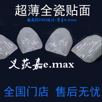 Dental veneers ultra-thin all-ceramic dental veneers Ivoclar veneers dental veneers whitening teeth veneers whitening teeth veneers