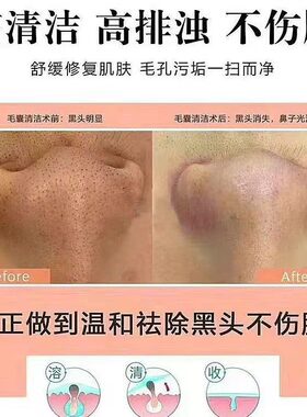 美容毛囊净化清洁黑头闭口导出