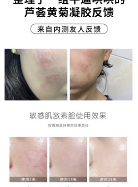 (稳定肌肤)库拉索芦荟黄菊凝胶100g舒缓修户痒红血丝红痒烫大干皮