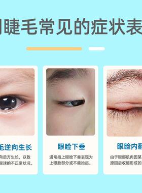 儿童成人倒睫毛贴非矫正