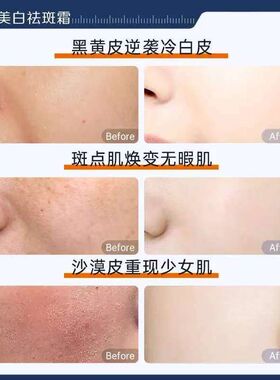 瑜然美377美白祛斑霜改善暗沉淡化色斑美白补水保湿舒缓面霜正品