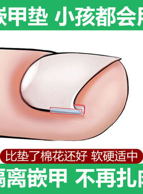 甲沟炎矫正利器指甲嵌甲专用隔离填充垫片脚趾甲往肉里长纠正甲贴
