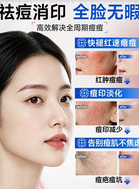 无酸胶态硫控油去红肿痘闭口淡印