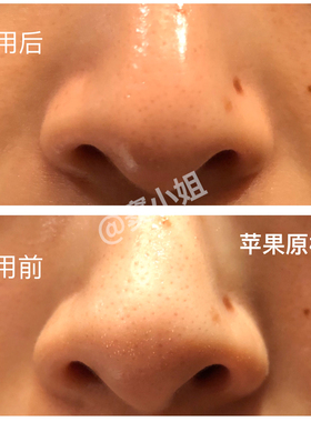 cnp导出黑头鼻贴收缩毛孔溶解
