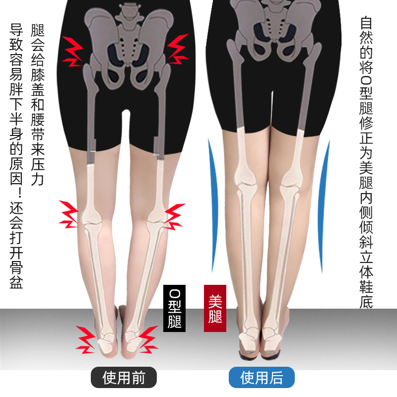 鞋底外侧磨损足内外翻矫正器罗圈腿脚后跟xo型小腿外翻校正鞋垫 - 图1