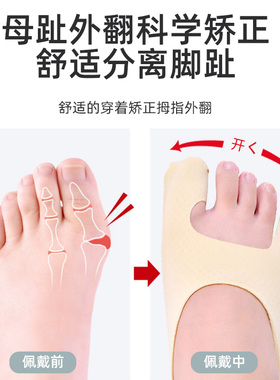 拇外翻矫正器分趾固定护指绷带