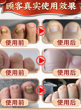 来和悦康灰甲护理液修复坏甲