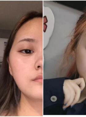 磨骨瘦脸骨咬肌苹果肌双下巴消颧骨缩下颌骨纠正脸型提拉紧致精华