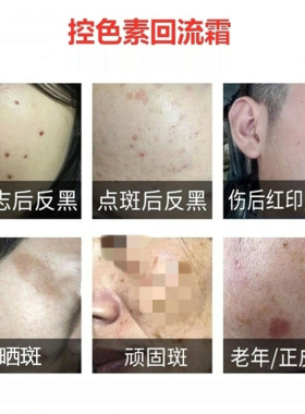 湖南痣美丽控色霜色素回流痘印霜