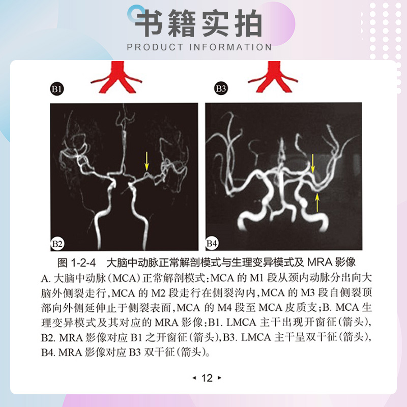 脑卒中血管超声华扬主编脑卒中防治系列丛书陇德超声入门血管超声经典教程ct血管成像诊断学解剖学图谱人民卫生出版社-图2