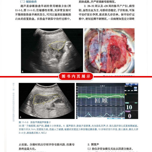 难产 第2二版 刘兴会 漆洪波助产士产科专业参考书实用妇产科手术学助产现代技术临床产科人卫版助产士书专业指南手册医生用书助产 - 图2