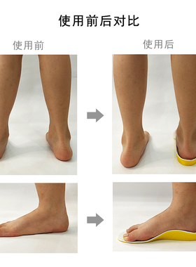 康立捷否3D打印足外翻矫正促销