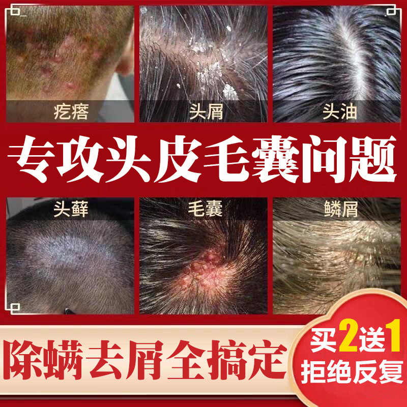 头皮癣去头屑 新人首单立减十元 21年7月 淘宝海外