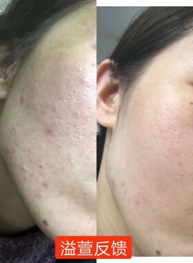 溢萱焕靓光感霜辅助缓解闭合粉刺 淡痘印提亮肤色滋润面霜