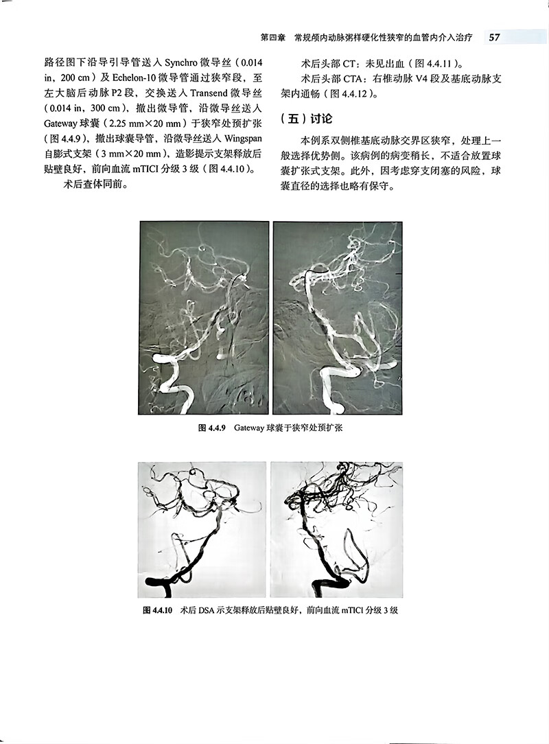 颅内动脉粥样硬化性狭窄血管内介入治疗 马宁 中英双语对照 ICAS研究血管内治疗技术临床精选病例9787565926969北京大学医学出版社 - 图1