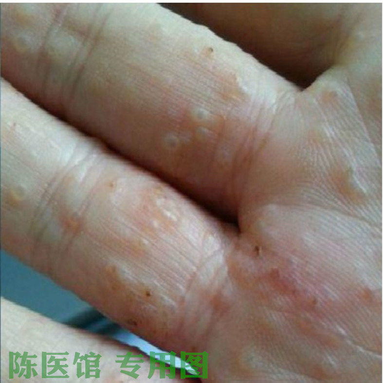 手指起水泡痒手痒手上起小水泡手上长小水泡专用中药抑菌止痒膏水,淘宝优惠券,粉丝福利购,淘宝优惠卷