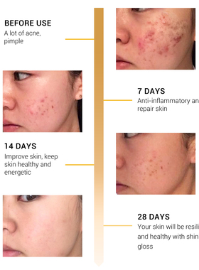 Snail Repairing Serum Anti-Acne Essence Scars蜗牛面部精华液