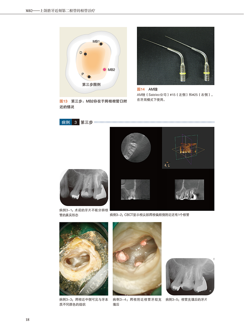 MB2上颌磨牙近颊第二根管的根管治疗 侯本祥等译 MB2从解剖形态到临床处理方法技能 口腔牙体牙髓病学临床诊疗 辽宁科学技术出版社 - 图3