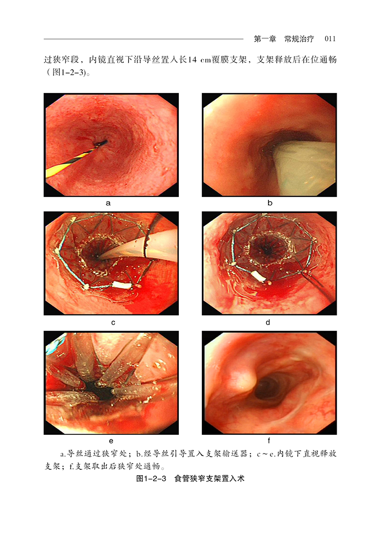 消化内镜治疗学典型病例图谱陈磊等编超声影像医学书籍超声内镜消化系统疾病诊断和治疗科学技术文献出版社9787518980208-图2
