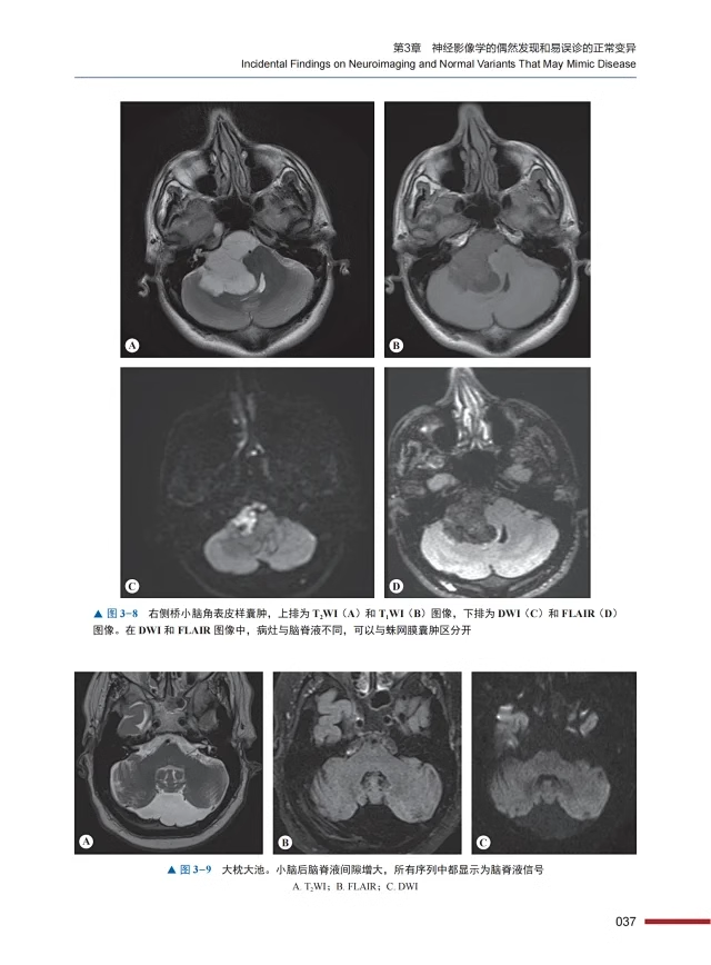 ESNR临床神经放射学上下全2卷张龙江刘亚欧主译神经系统各类疾病影像学表现临床经典病例中国科学技术出版社9787523600979-图3
