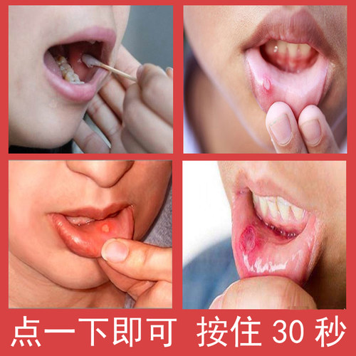 牙得安一点灵 口腔不适粘膜护理 口舌起泡白点疼痛 送专用涂药棒 - 图1