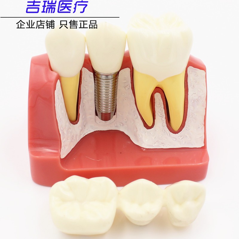 牙科 4倍种植解模型 义齿修复种植牙解说 可拆卸 连桥牙冠 种植模 - 图0