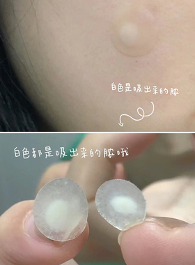 品牌直供oliveyoung隐形痘痘贴