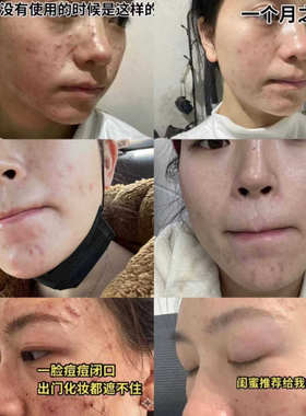 苗悦美方祛痘青春痘痘印修护精华