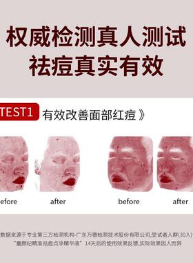 童颜纪精准祛痘点涂精华液温和瘪痘救急去痘控油舒缓敏感肌可用