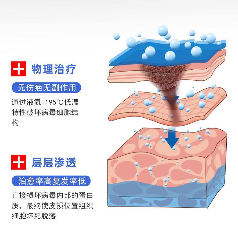 液氮冷冻去疣液态氮冷冻家用液氮喷雾小瓶装-图1