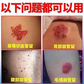 ການກໍາຈັດເວລາກາງຄືນ] Hemangioma n-ຢາກໍາຈັດ mole ດ້ວຍ sponge ໄຫມ strawberry ເພື່ອເອົາສີແດງແລະ redness subcutaneous.