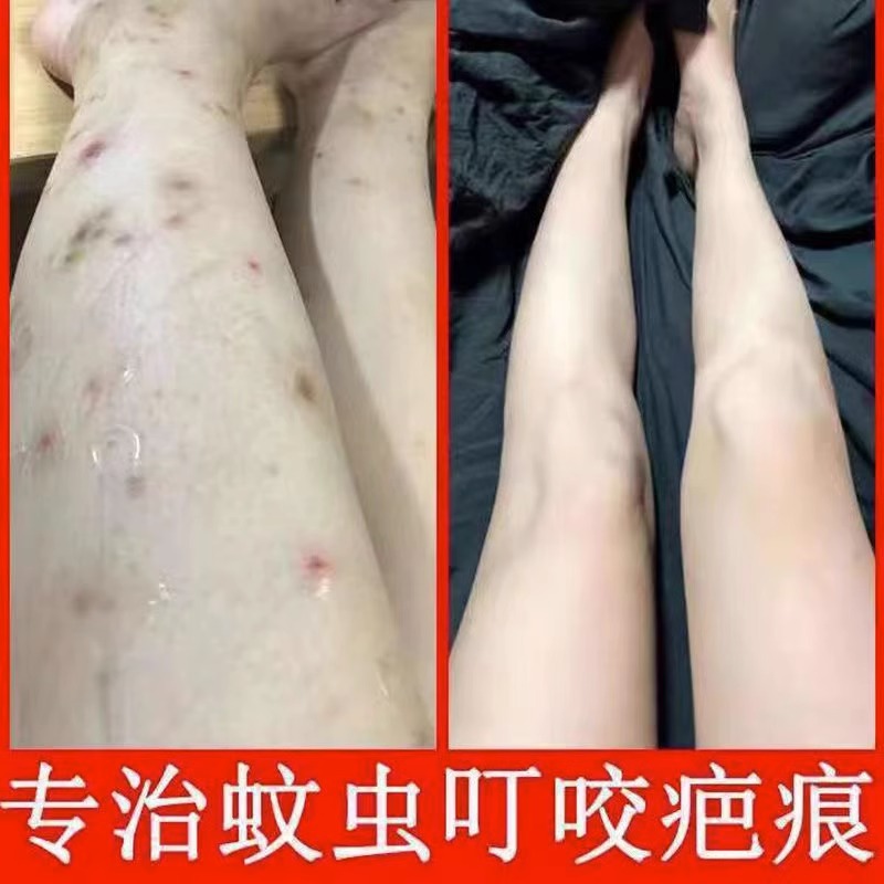 叮着祛疤膏去咬痕修复除疤去蚊子G疤印黑印淡化色素沉疤沉 - 图2