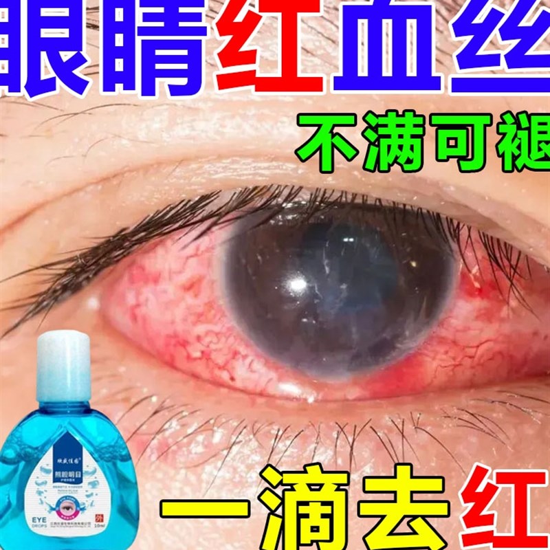 现货速发眼睛红血丝修复去除去黄去红血丝滴眼液缓解眼睛疲劳粘稠 - 图0