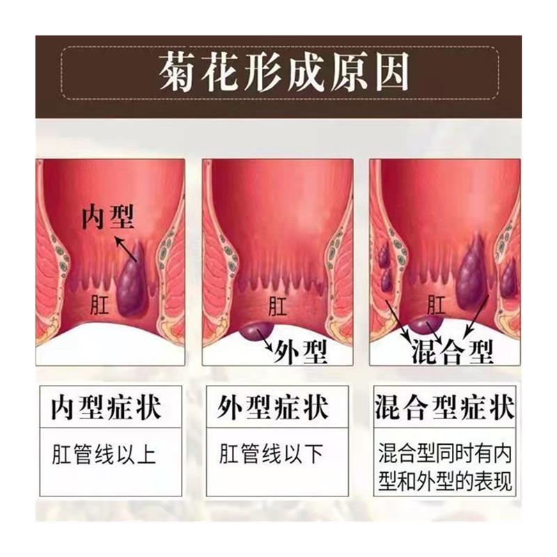 厂家正宗华佗断痔膏 内痔外痔混合痔 肉球便血肛瘘肛门 - 图3