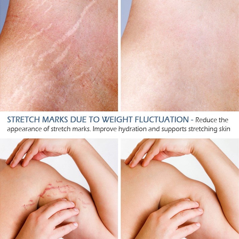 推荐Stretch Marks Remover Essential Oil Skin Care Treatment - 图3