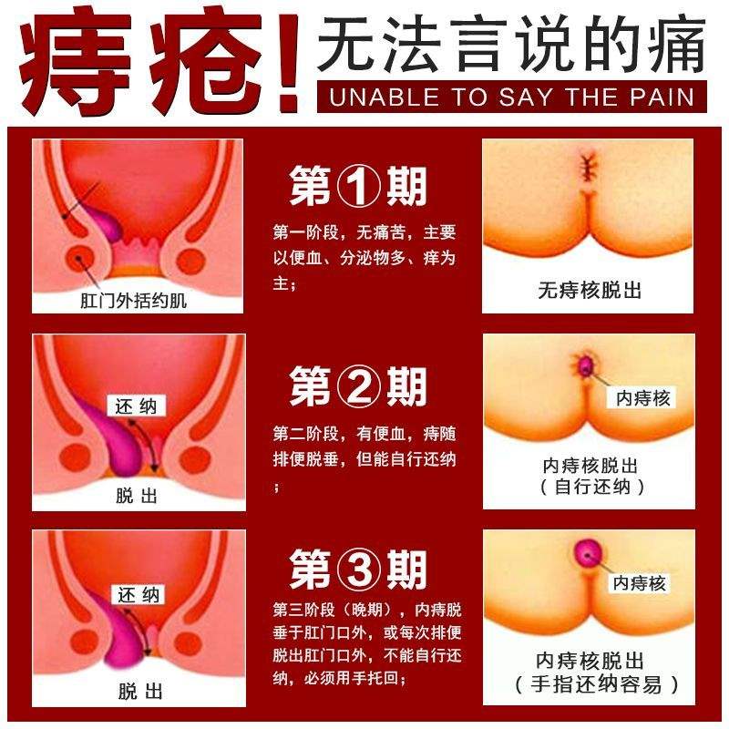 新品无花果叶子痔疮特效中药坐浴薰洗包偏方治疗肛周脓硬块肿疼消 - 图2