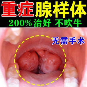 腺样体肥大中药贴治疗儿童鼻塞张嘴呼吸不通气调理面容矫正器XZ