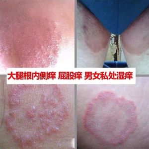 股藓膏体股藓大腿内侧瘙痒股癣真菌感染屁股私处股藓湿疹专用药膏