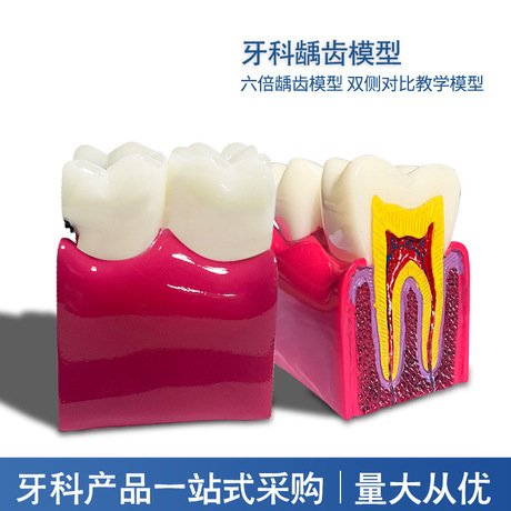 牙科教学器材6倍龋齿对比模型口腔模型教学模型牙齿模型