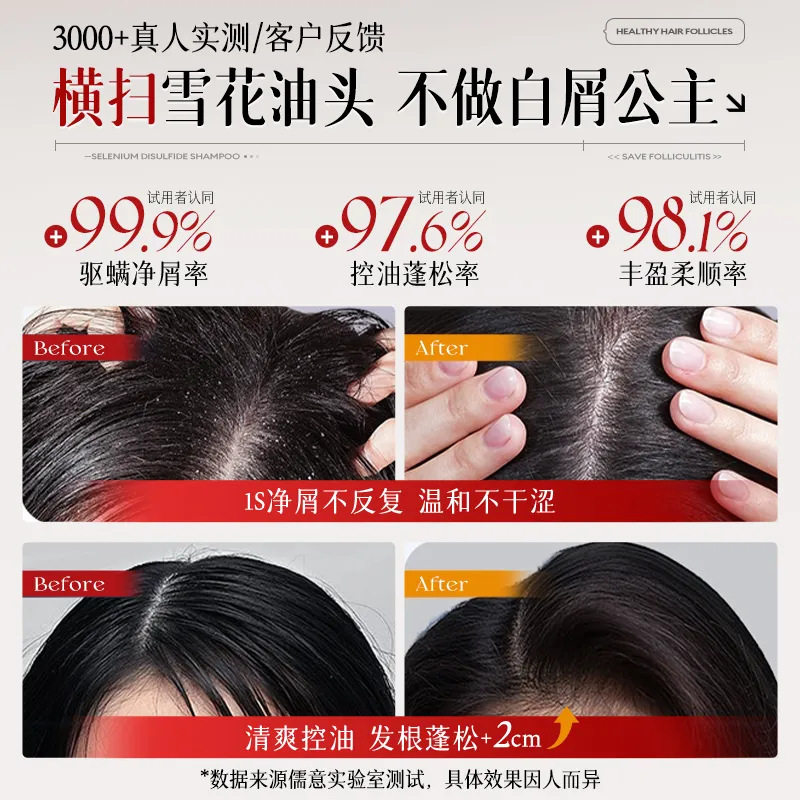 Selenium Disulfide Hair Follicle Cleansing Shampoo, Anti-Dandruff, Anti-Itch, Mite Removal, Oil Control, Fluffy Inflammation Shampoo, Brand Genuine