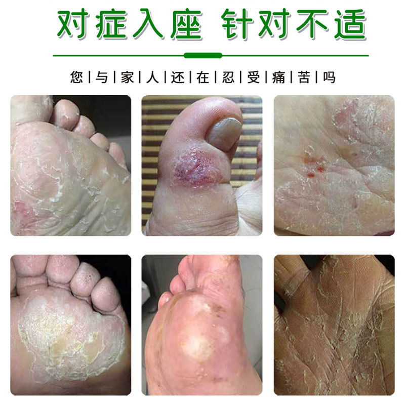 止痒快克抑菌止痒膏去菌膏脚臭脚痒皮肤瘙痒祛痱去癣脚气湿痒水泡 - 图1