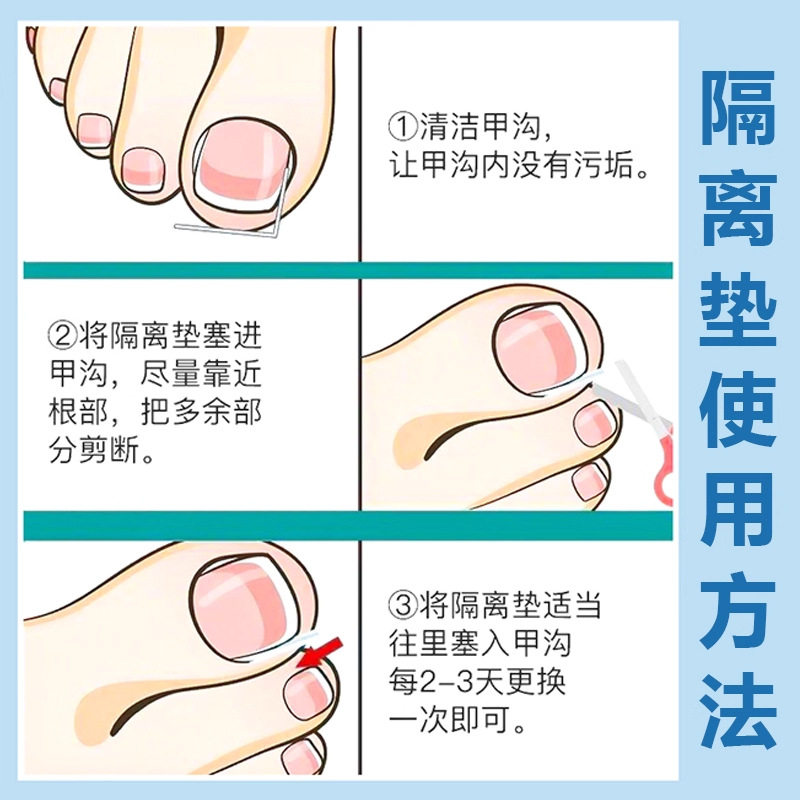 Nail Groove Corrector Ingrown Toenail Universal Filling Pad Toenail Prevention Tool for Preventing Nails from Growing into the Flesh Nail Correction Tool
