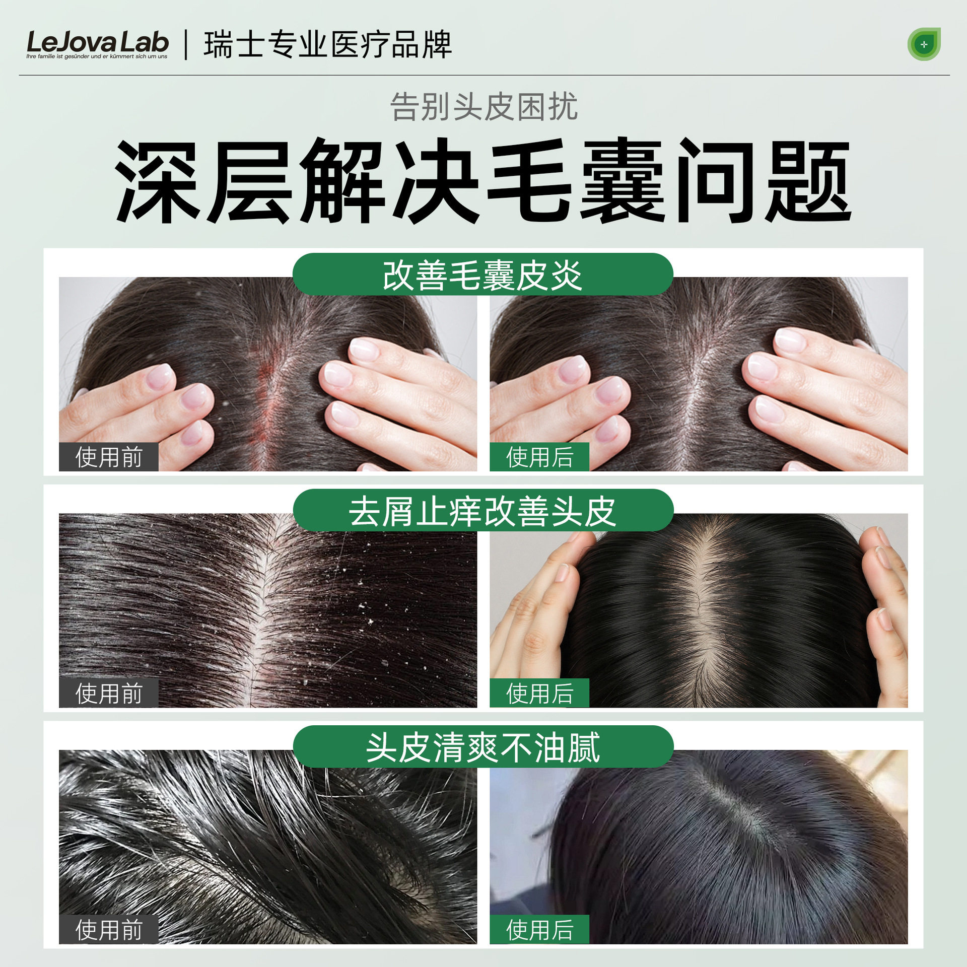 Coal Tar Lotion, Anti-Dandruff, Anti-Itch, Anti-Mite, Oil-Control, Anti-Bacterial Liquid Shampoo, Wholesale Refreshing Scalp Support, Customized Patch