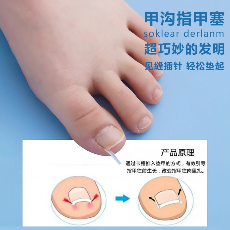 Nail Groove Corrector Ingrown Toenail Universal Filling Pad Toenail Prevention Tool for Preventing Nails from Growing into the Flesh Nail Correction Tool