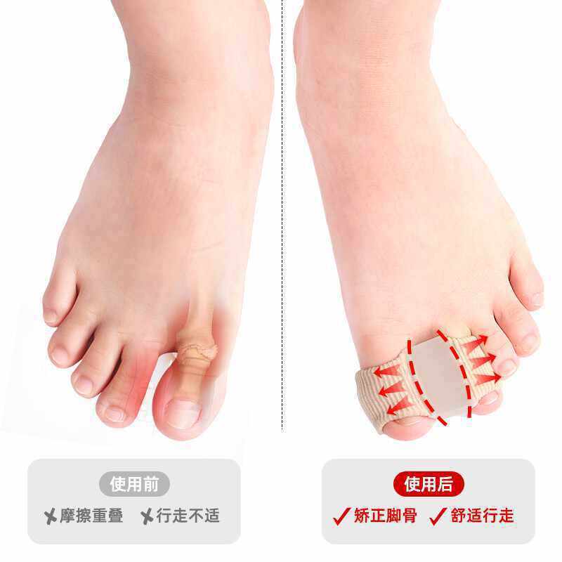 Toe Valgus Corrector for Men and Women Elastic Bandage Toe Valgus Correction Toe Separator Overlapping Separator Toe Pad