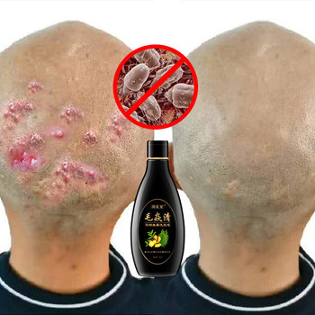 Zhouyitang Hair Inflammation Cleansing Shampoo Removes Mites, Hair Follicles, Anti-Dandruff, Anti-Itching, Head Seborrheic Antibacterial Oil Control Shampoo